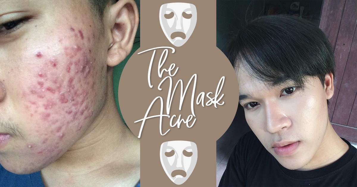 The Mask Acne | ถอดหน้ากากสิว