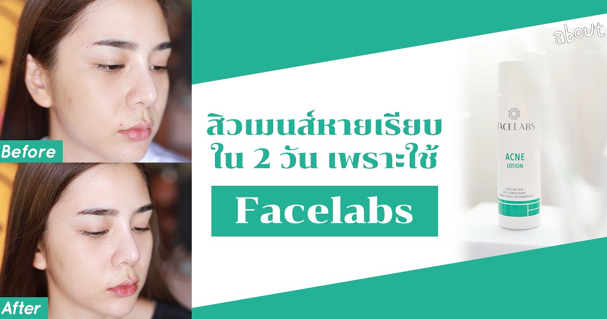 Face Lab Solution สิวเมนส์หายเรียบใน 2 วัน เพราะใช้ Facelabs