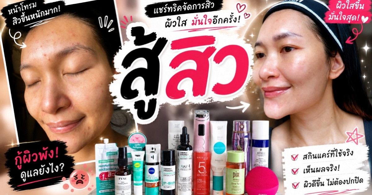 หน้าพังเพราะสิว! แต่กลับมาผิวใสได้ แชร์ทุกอย่างที่ทำจริง | สู้สิว✨ 