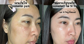 รีวิวหลังใช้ ครีมกำจัดฝ้า กระ cosmelan2 ครบ 14 วัน กระโหนกแก้มจางลงจนกล้าหน้าสดอีกครั้ง!