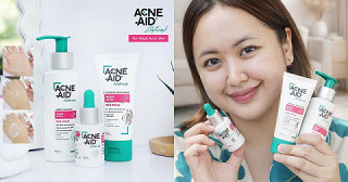 รีวิว Acne-Aid Adult Acne ตัวช่วยจัดการสิวฮอร์โมนของคนโต สิวลด ผิวเริ่มบาลานซ์ขึ้น
