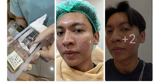 แชร์ประสบการณ์ฟื้นฟูผิว หลังจากหาวิธีดูแลหลุมสิวมาหลายปี