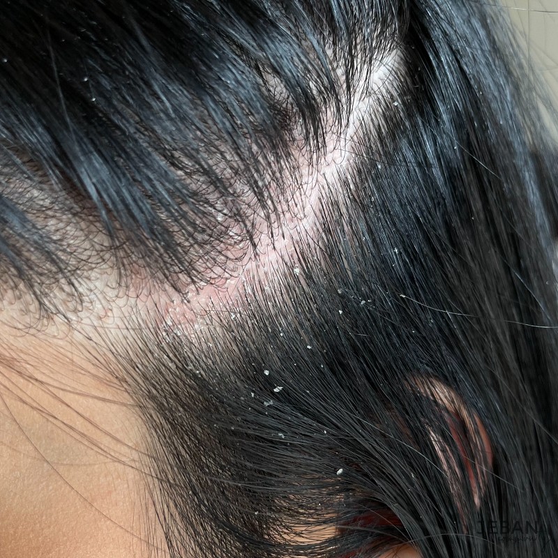 รายการ 98+ ภาพ ย้อมผมแล้วหนังหัวลอก คมชัด รายการ 98+ ภาพ ย้อมผมแล้วหนังหัวลอก คมชัด