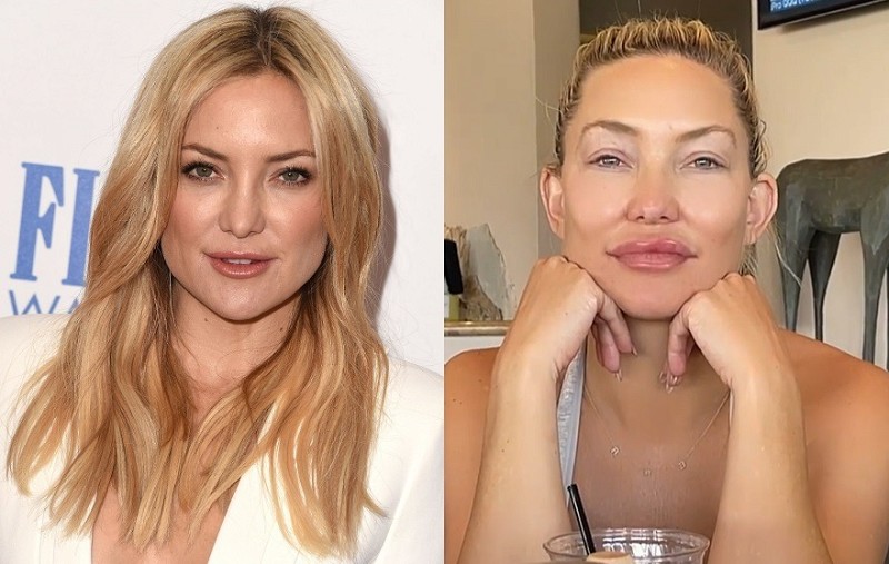 เหตุใด คนดังจึงเริ่มหันมาเอาFiller ออก(02)