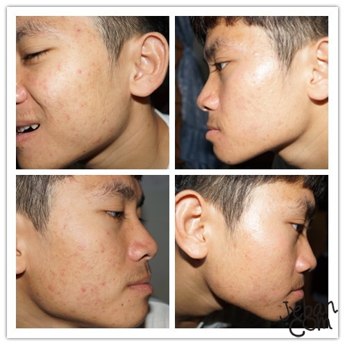 ร ว วร กษาส วให ค ณแฟน